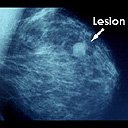 маммограмма рака молочной железы