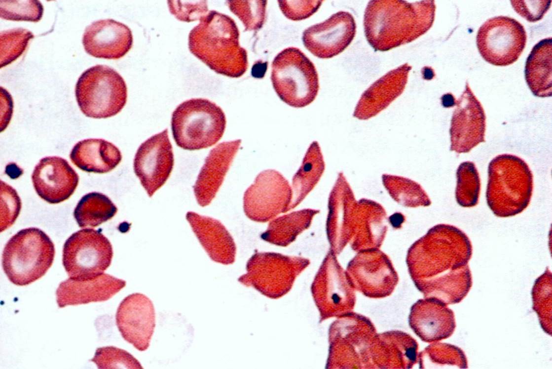 Анемия и эритроциты в крови. Периферическая кровь при серповидноклеточной анемии. Железодефицитная анемия пойкилоцитоз. Железодефицитная анемия картина периферической крови. Эритроциты в крови анемия.